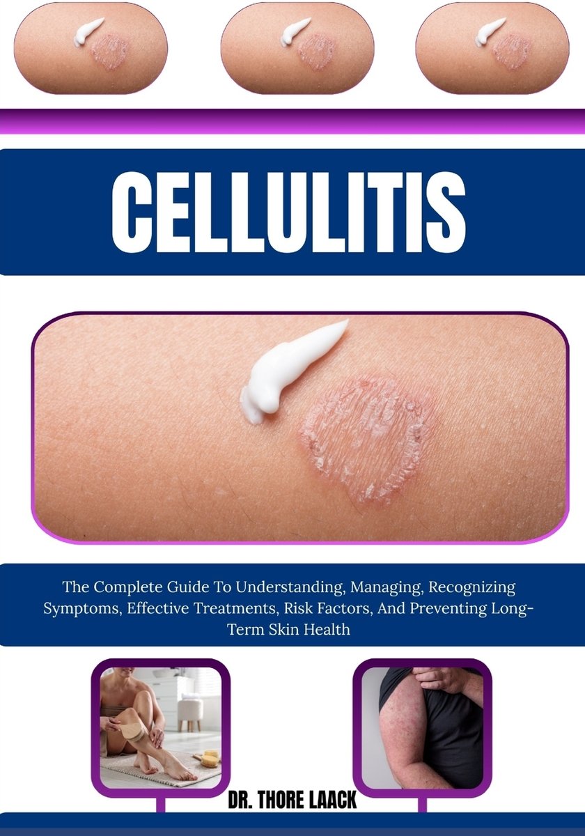 Cellulitis a book by Dr Thore Laack - Bookshop.org US
