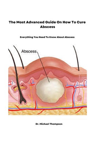 The Most Advanced Guide On How To Cure Abscess: Everything You Need To ...