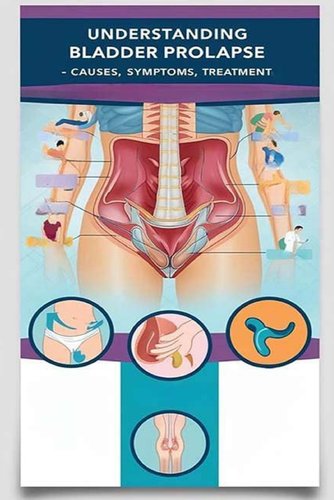 Understanding Bladder Prolapse - Causes, Symptoms, Treatment: Bladder ...